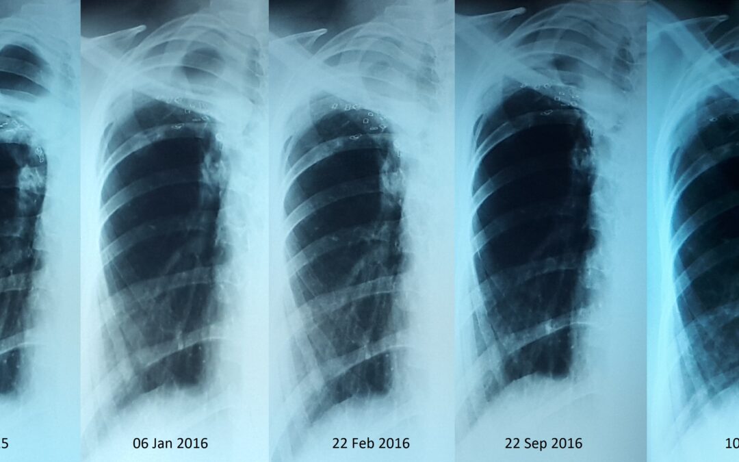 Бронхоплевральный свищ.