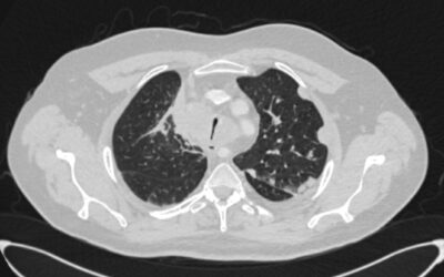 Стентирование трахеи; Плоскоклеточный рак