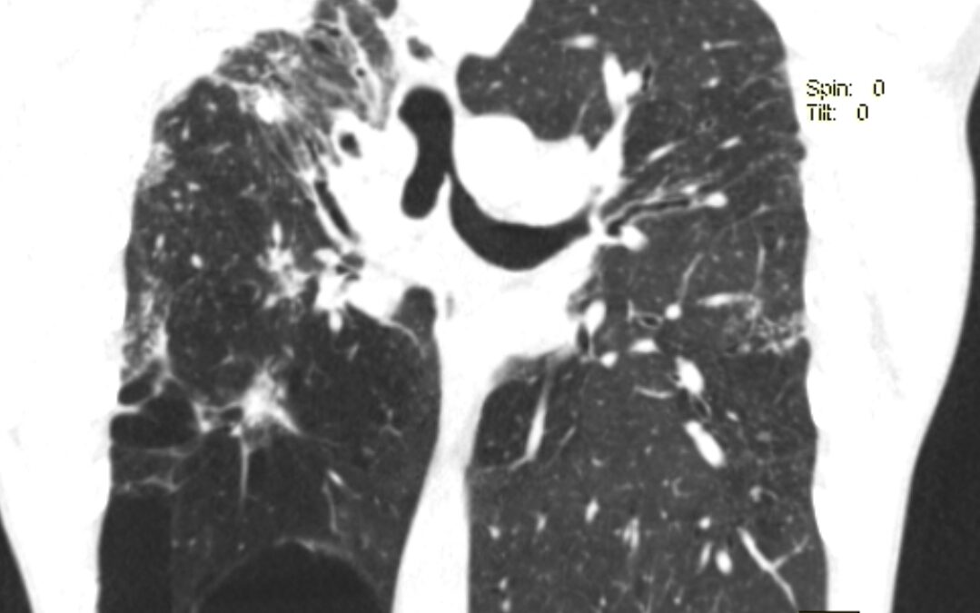 ტრაქეობრონქიალური სტენტირება, მარცხენა მთავარი ბრონქის ნაწიბუროვანი სტენოზი