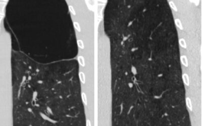 ფილტვის მოცულობის ბრონქოსკოპიული შემცირება ბულოზური ემფიზემის შემთხვევაში