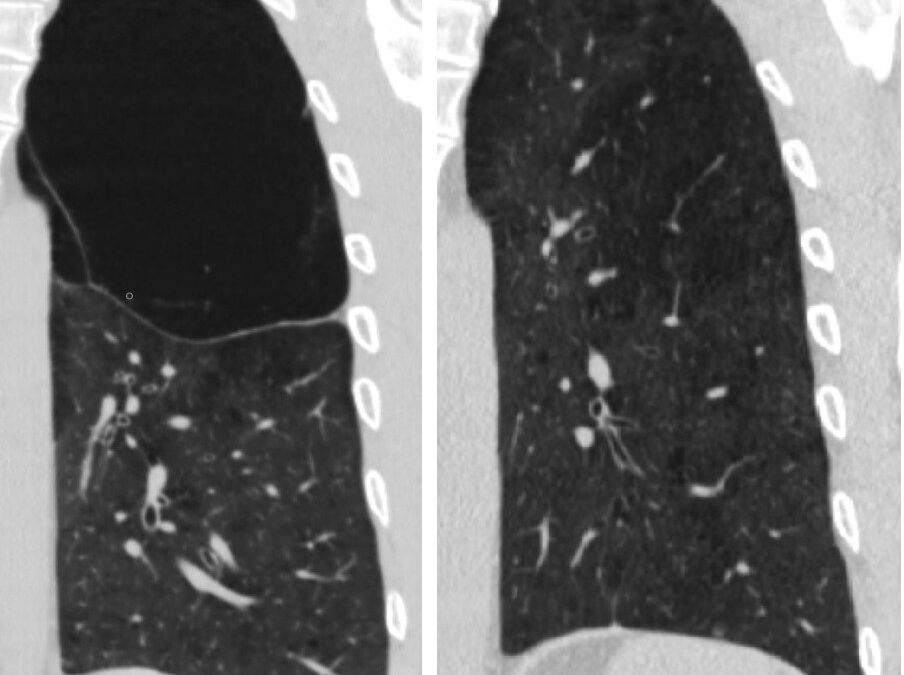 ფილტვის მოცულობის ბრონქოსკოპიული შემცირება ბულოზური ემფიზემის შემთხვევაში