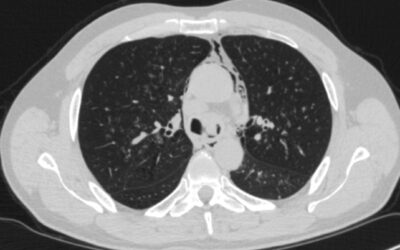Laser Resection & Stenting; NSCLC