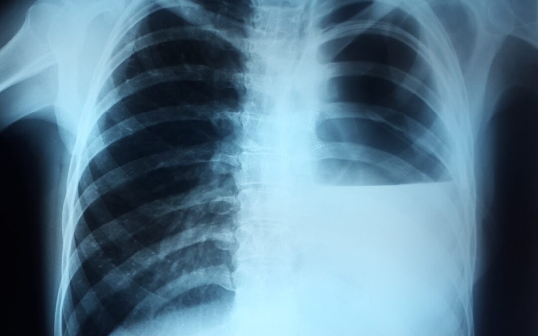 პიოთორაქსი ფისტულით