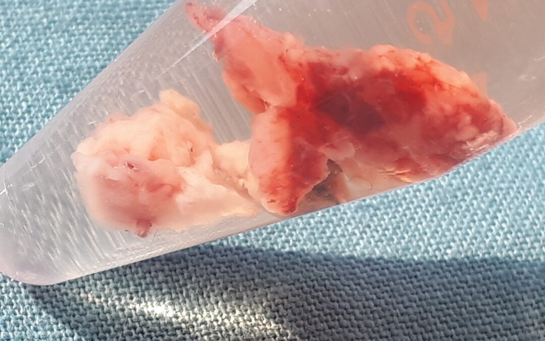 მარცხენა მთავარი ბრონქის ბრტყელუჯრედოვანი კარცინომის რეზექცია და სტენტირება