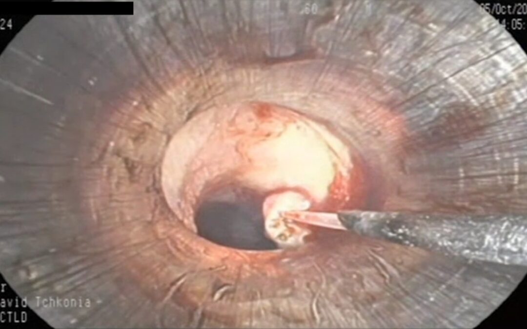 ტრაქეის და მარჯვენა მთავარი ბრონქის  არაწვრილუჯრედოვანი კარცინომის ლაზერული რეზექცია