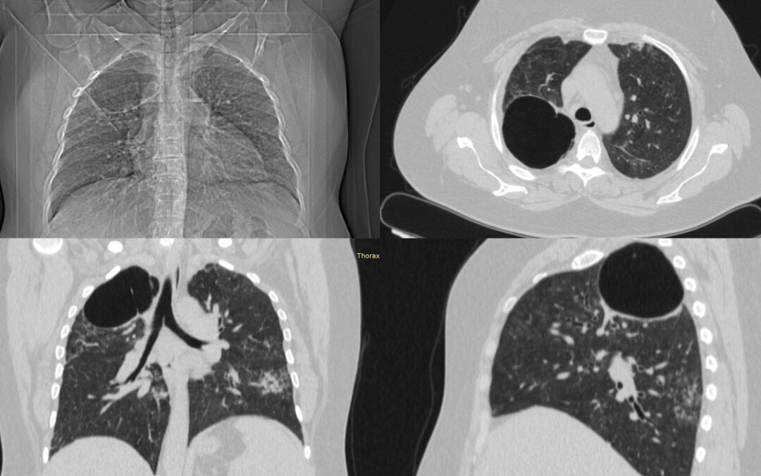 გიგანტური ბულის სარქვლოვანი ბრონქობლოკაცია