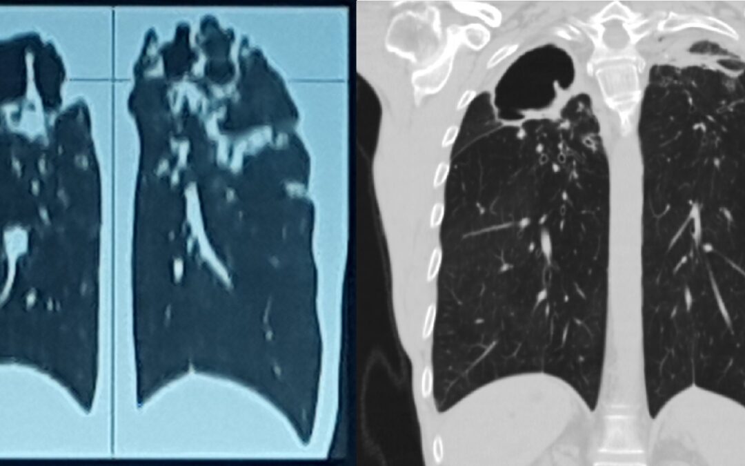 მარცხენა ზ/წ ბრონქის სარქვლოვანი ბრონქობლოკაცია პოსტტუბერკულოზური კავერნებიდან სისხლდენის გამო