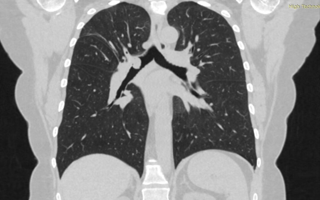 მარჯვენა მთავარი ბრონქის ტიპური კარცინოიდის ლაზერული რეზექცია