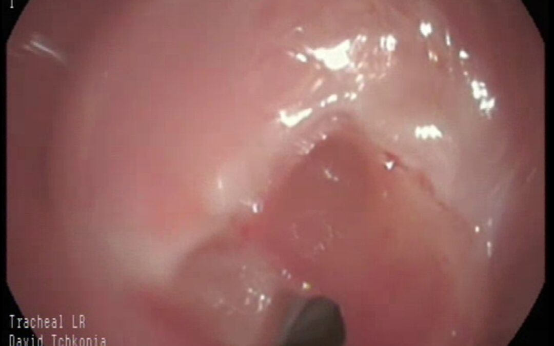 ტრაქეის პოსტინტუბაციური ნაწიბუროვანი სტენოზის ლაზერული რეზექცია
