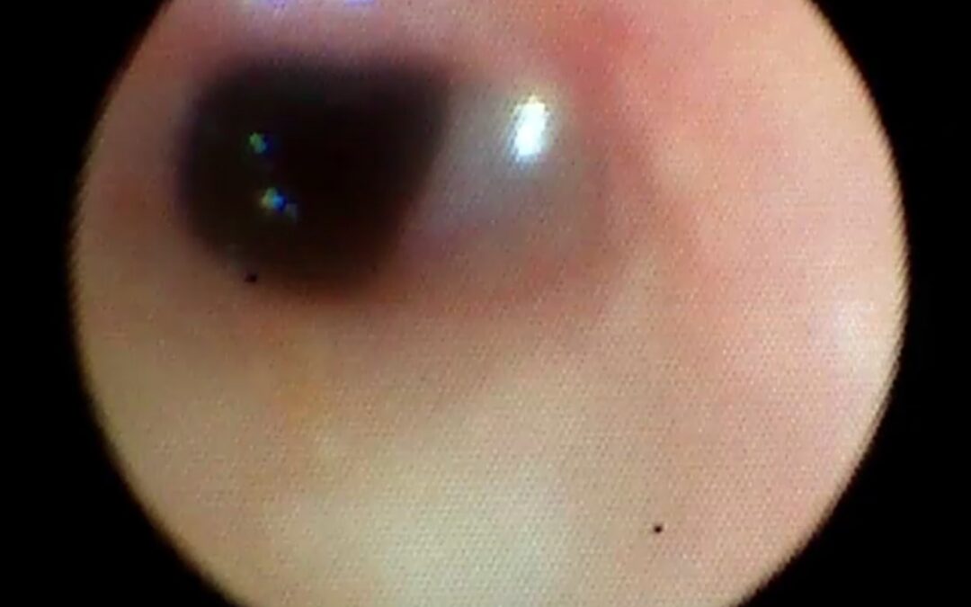 მარცხენა მთავარი ბრონქის ბრონქობლოკაცია ტაკვის ბრონქო-პლევრული ფისტულის გამო