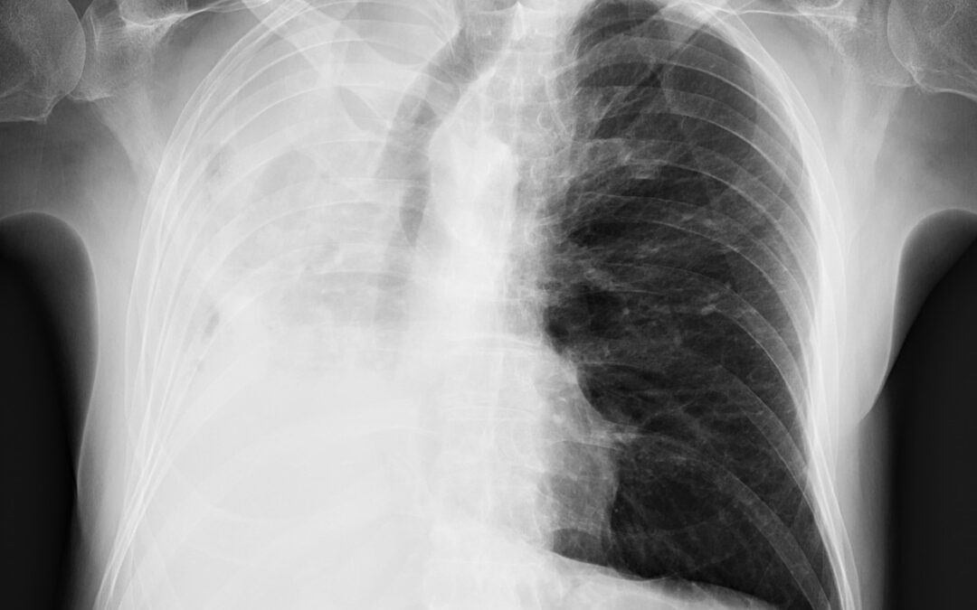 მარჯვენა მთავარი ბრონქის სტენტირება სიმსივნური ობტურაციის გამო