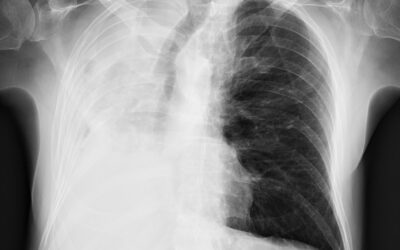 მარჯვენა მთავარი ბრონქის სტენტირება სიმსივნური ობტურაციის გამო